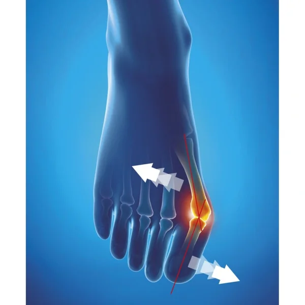 Epitact Hallux Valgus Orthèse Corrective de Nuit